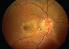 Neuroretinitis is not a true ON rather MACULOPATHY. The star appearance of the macula is a late sign.
