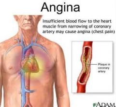 Angina (stable: with moderate exertion; unstable: with minimal exertion)