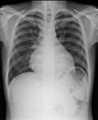 Chest pain, pericardial effusion/friction rub, persistent fever following MI