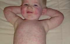 Child with fever later develops red rash on face that spreads to body