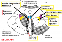 Internuclear ophthalmoplegia (damage to medial longitudinal fasciculus; bilateral [multiple sclerosis], unilateral [stroke])