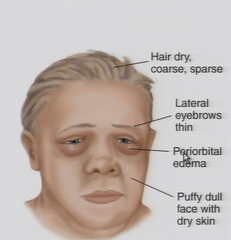 Cutaneous/dermal edema due to connective tissue deposition