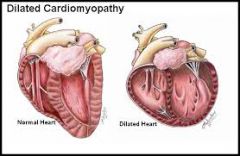Dilated cardiomyopathy, edema, alcoholism or malnutrition