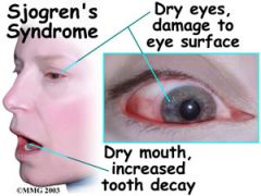 Sjögren syndrome (autoimmune destruction of exocrine glands)