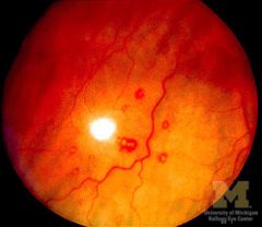 "White-centered" hemorrhages seen on the retina secondary to immune complex vasculitis

Associated with infective endocarditis (not specific)