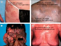 Mycosis fungoides (cutaneous T-cell lymphoma) or Sézary syndrome (mycosis fungoides + malignant T cells in blood)