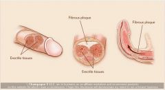 Fibrous plaques in soft tissue of penis