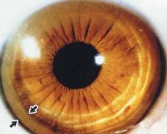 Green-yellow rings around peripheral cornea