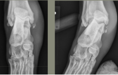 On the right side of this fracture, what opacity is seen?
