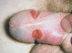 Indurated, ulcerated genital lesion