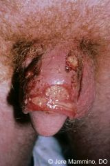 SIDE 1: Nonpainful chancre (1° syphilis, Treponema pallidum)


SIDE 2: Painful chancroid with exudate (Haemophilus ducreyi)