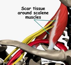 Thoracic outlet syndrome by compressing the subclavian artery and the brachial plexus as they exit b/e the anterior and middle scalenes