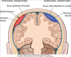 Epidural hematoma (middle meningeal artery rupture)