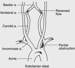Narrowing of the subclavian artery proximal to the origin of the vertebral artery causes exercise in the upper limb to steal blood from the brain via the vertebral artery.