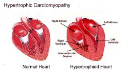Myopathy (infantile hypertrophic cardiomyopathy), exercise intolerance