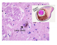 Lewy bodies: Accumulation of α-synuclein inside nerve cells