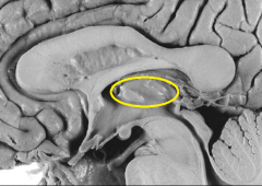 Identify this structure as seen from the sagittal view of the diencephalon. 