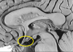 Identify this structure as seen from the sagittal view of the diencephalon. 