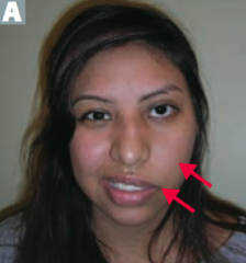 Peripheral ipsilateral facial paralysis (drooping smile) with inability to close eye on involved side