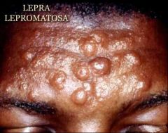 Lepra lepromatosa