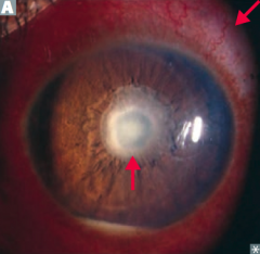 What causes sterile pus (hypopyon) and conjunctival redness?