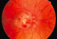 What eye condition is associated with retinal edema and necrosis leading to a scar?