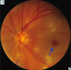 Central Retinal Artery Occlusion:
- Retina appears cloudy with attenuated vessels
- Cherry-red spot at fovea