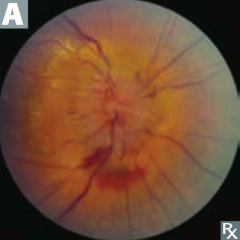 Enlarged blind spot and elevated optic disc with blurred margins on fundoscopic exam