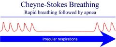 Cheyne-Stokes respirations (central apnea in CHF or intracranial pressure)