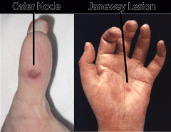 Janeway lesions (infective endocarditis, septic emboli/ microabscesses)