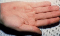 Painless erythematous lesions on palms and soles