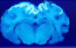 Brain appears like this under UV light- diagnosis?