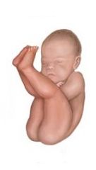 What kind of breeched position is this baby in?