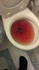 Red urine in the morning, fragile RBCs