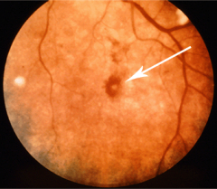 Retinal hemorrhages with pale centers