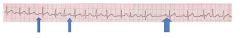 3 different P waves creating arrhythmia

need to treat underlying condition, often hypoxemia