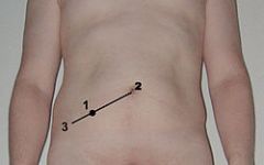 McBurney sign ( McBurney's point (1), located two thirds the distance from the umbilicus (2) to the rightanterior superior iliac spine (3),acute appendicitis)
