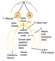 4. Left Upper Quadrantic Anopia - R temporal lesion (Meyer loop), MCA