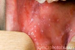 Small, irregular red spots on buccal/lingual mucosa with blue-white centers