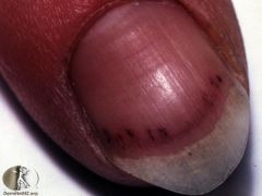 Splinter hemorrhages in fingernails