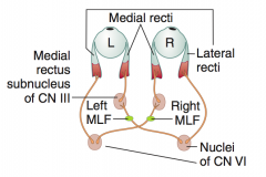 Lesion of Medial Longitudinal Fasciculus (MLF)
- Lack of communication, such that when CN VI nucleus activates ipsilateral lateral rectus, contralateral CN III nucleus does not stimulate medial rectus to fire
- Abducting eye gets nystagmus (CN V...