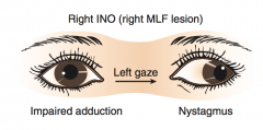 Directional term - refers to which eye is paralyzed