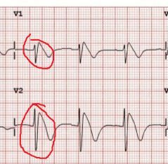 Right ventricle, spontaneous, can lead to VT

Repolarization problem

appears as landslide on ECG
