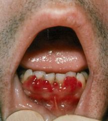 Swollen gums, mucosal bleeding, poor wound healing, petechiae