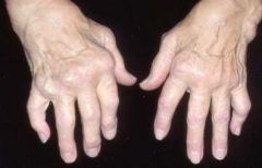 Swollen, hard, painful finger joints