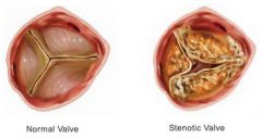 Aortic valve stenosis