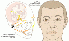 Facial nerve (LMN CN VII palsy)