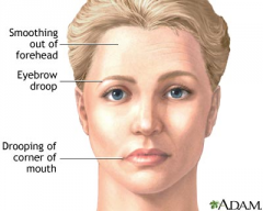 Unilateral facial drooping involving forehead