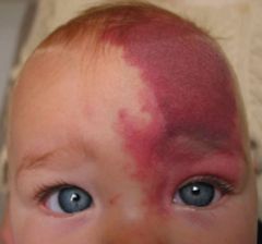 Vascular birthmark (port-wine stain)