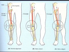 GENU VALGUS promotes LATERAL DISLOCATION of patella in women.  Greater LATERAL PULL by quads on the patella - due to wider hips.